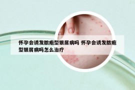 怀孕会诱发脓疱型银屑病吗 怀孕会诱发脓疱型银屑病吗怎么治疗