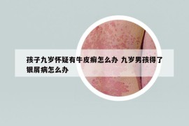 孩子九岁怀疑有牛皮癣怎么办 九岁男孩得了银屑病怎么办