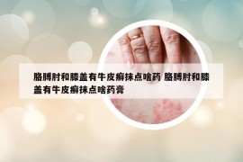 胳膊肘和膝盖有牛皮癣抹点啥药 胳膊肘和膝盖有牛皮癣抹点啥药膏