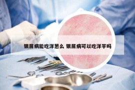 银屑病能吃洋葱么 银屑病可以吃洋芋吗