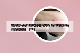 银屑病与脑白质脱髓鞘有关吗 脑白质病和脑白质脱髓鞘一样吗