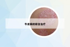 牛皮癣的综合治疗