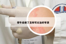 得牛皮癣了怎样可以治好早泄