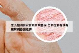 怎么检测有没有银屑病基因 怎么检测有没有银屑病基因遗传