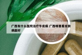 广西有什么医院治疗牛皮癣 广西哪里看皮肤病最好