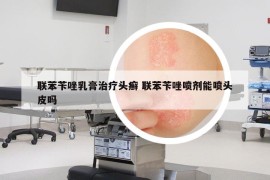 联苯苄唑乳膏治疗头癣 联苯苄唑喷剂能喷头皮吗