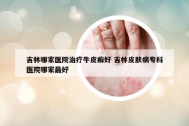 吉林哪家医院治疗牛皮癣好 吉林皮肤病专科医院哪家最好