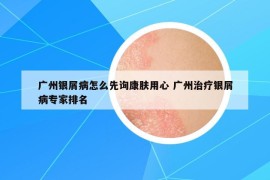 广州银屑病怎么先询康肤用心 广州治疗银屑病专家排名