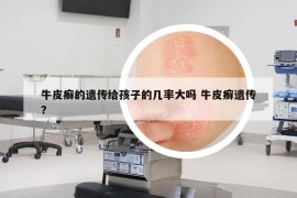 牛皮癣的遗传给孩子的几率大吗 牛皮癣遗传?