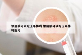 银屑病可以吃玉米棒吗 银屑病可以吃玉米棒吗图片