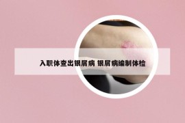 入职体查出银屑病 银屑病编制体检