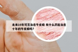 未来10年可否治愈牛皮癣 有什么药能治愈十年的牛皮癣吗?