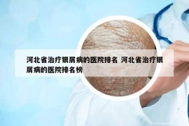 河北省治疗银屑病的医院排名 河北省治疗银屑病的医院排名榜