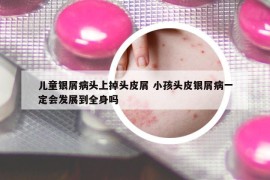儿童银屑病头上掉头皮屑 小孩头皮银屑病一定会发展到全身吗