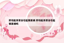 肝功能异常会引起银屑病 肝功能异常会引起银屑病吗