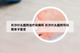 长沙什么医院治疗白癜风 长沙什么医院可以做亲子鉴定