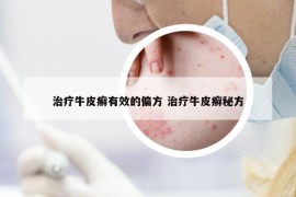 治疗牛皮癣有效的偏方 治疗牛皮癣秘方