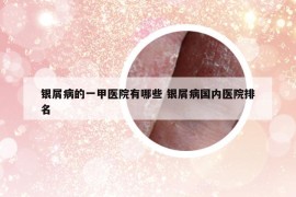 银屑病的一甲医院有哪些 银屑病国内医院排名