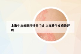 上海牛皮癣医院特需门诊 上海看牛皮癣最好的