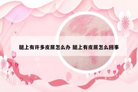 腿上有许多皮屑怎么办 腿上有皮屑怎么回事