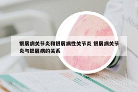银屑病关节炎和银屑病性关节炎 银屑病关节炎与银屑病的关系
