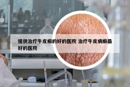 提供治疗牛皮癣的好的医院 治疗牛皮病癣最好的医院