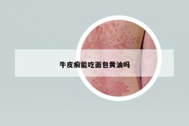 牛皮癣能吃面包黄油吗