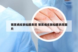 银屑病皮肤粘膜表现 银屑病皮肤粘膜表现图片