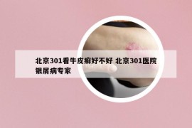 北京301看牛皮癣好不好 北京301医院银屑病专家