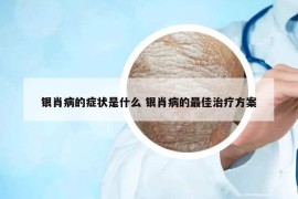 银肖病的症状是什么 银肖病的最佳治疗方案