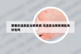 那里的温泉能治银屑病 泡温泉治银屑病能有好处吗