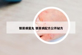 银屑病蜜丸 银屑病配方公开秘方
