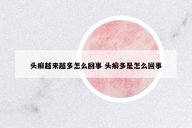 头癣越来越多怎么回事 头癣多是怎么回事