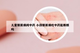 儿童银屑病纯中药 小孩银屑病吃中药能断根吗