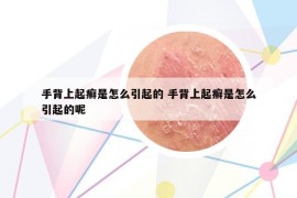 手背上起癣是怎么引起的 手背上起癣是怎么引起的呢