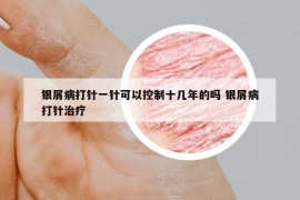 银屑病打针一针可以控制十几年的吗 银屑病打针治疗