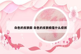 白色的皮肤藓 白色的皮肤癣是什么症状
