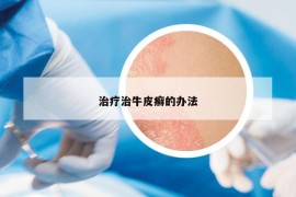 治疗治牛皮癣的办法