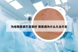 为啥银屑病不容易好 银屑病为什么久治不愈