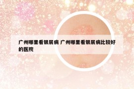 广州哪里看银屑病 广州哪里看银屑病比较好的医院