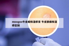 moogoo牛皮癣和湿疹膏 牛皮肤癣和湿疹区别