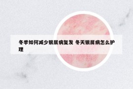 冬季如何减少银屑病复发 冬天银屑病怎么护理