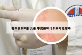 有牛皮癣喝什么茶 牛皮癣喝什么茶叶能排毒