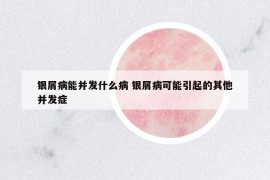 银屑病能并发什么病 银屑病可能引起的其他并发症