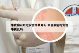 牛皮癣可以吃安宫牛黄丸吗 银屑病能吃安宫牛黄丸吗