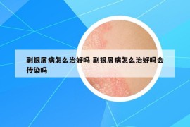 副银屑病怎么治好吗 副银屑病怎么治好吗会传染吗