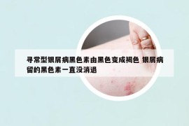 寻常型银屑病黑色素由黑色变成褐色 银屑病留的黑色素一直没消退