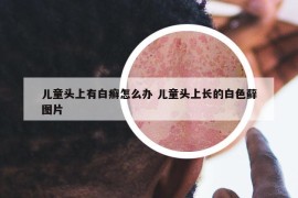 儿童头上有白癣怎么办 儿童头上长的白色藓图片