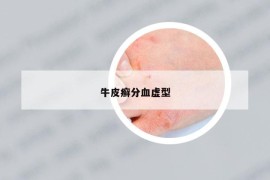 牛皮癣分血虚型