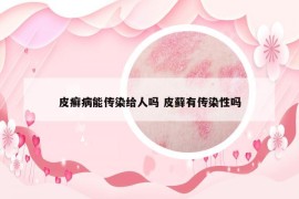 皮癣病能传染给人吗 皮藓有传染性吗